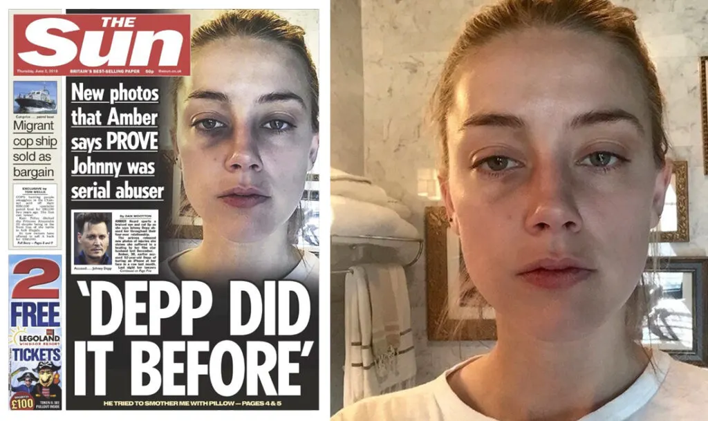The Sun Newspaper, with enhanced bruise detail